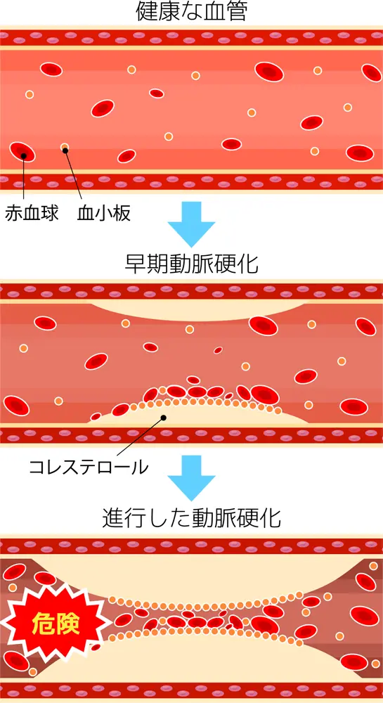 その他の脂 質 安い 血症